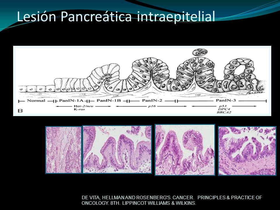 neoplasia duttale intraepiteliale neoplasia duttale intraepiteliale